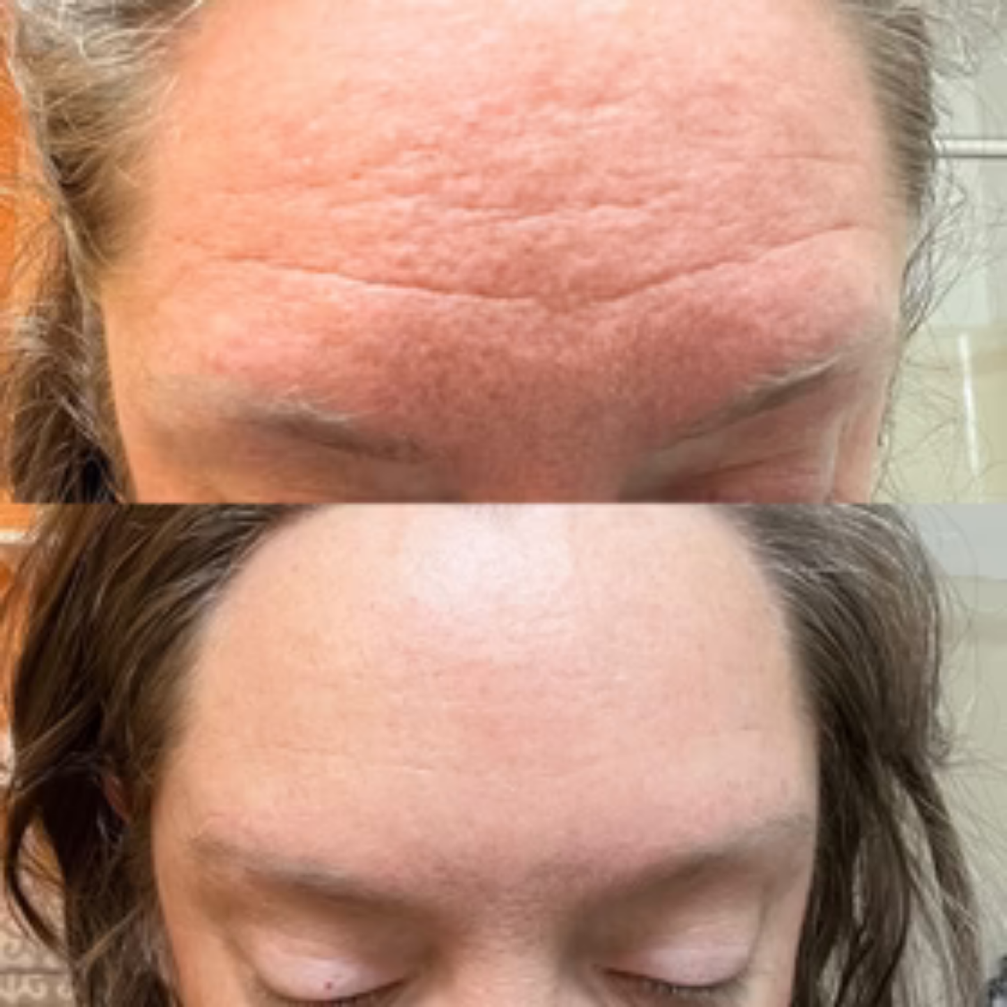 Second Skin™ – Forehead & 11 Lines Smoother