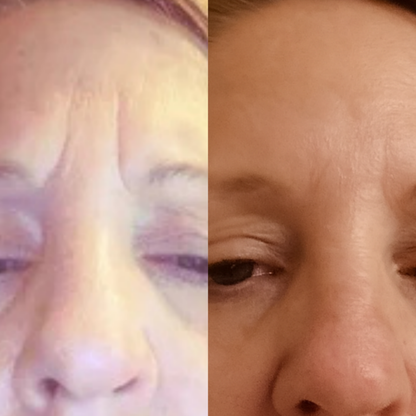 Second Skin™ – Forehead & 11 Lines Smoother