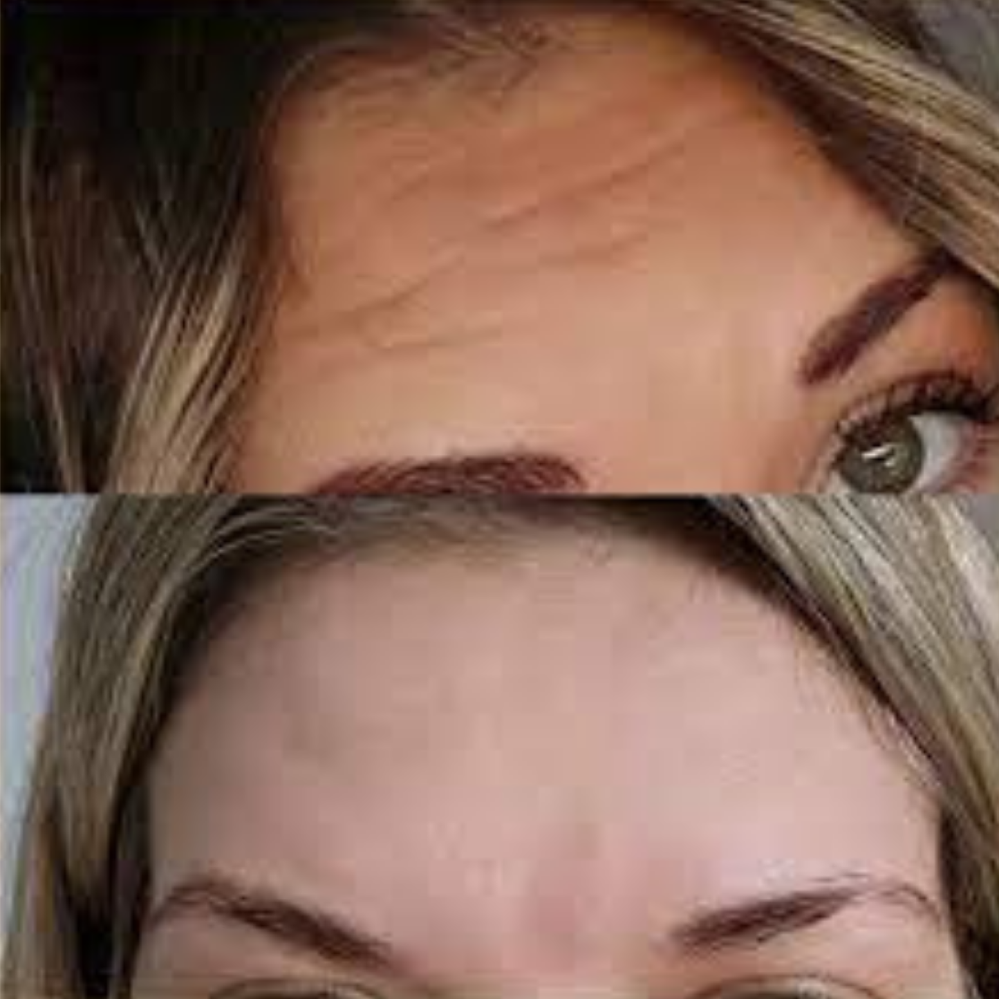 Second Skin™ – Forehead & 11 Lines Smoother