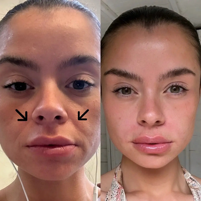Smile Line Smoothing Patches