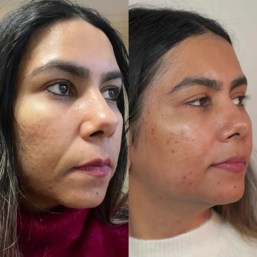 Smile Line Smoothing Patches