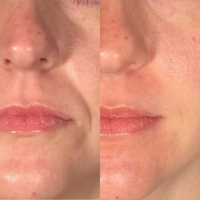 Smile Line Smoothing Patches