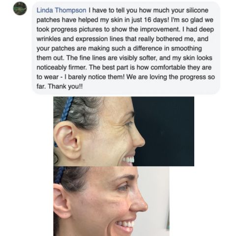 Losveo™ - Silicone Scar Sheets