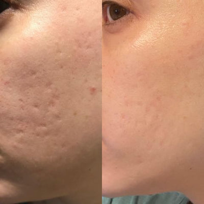 Losveo™ - Silicone Scar Sheets