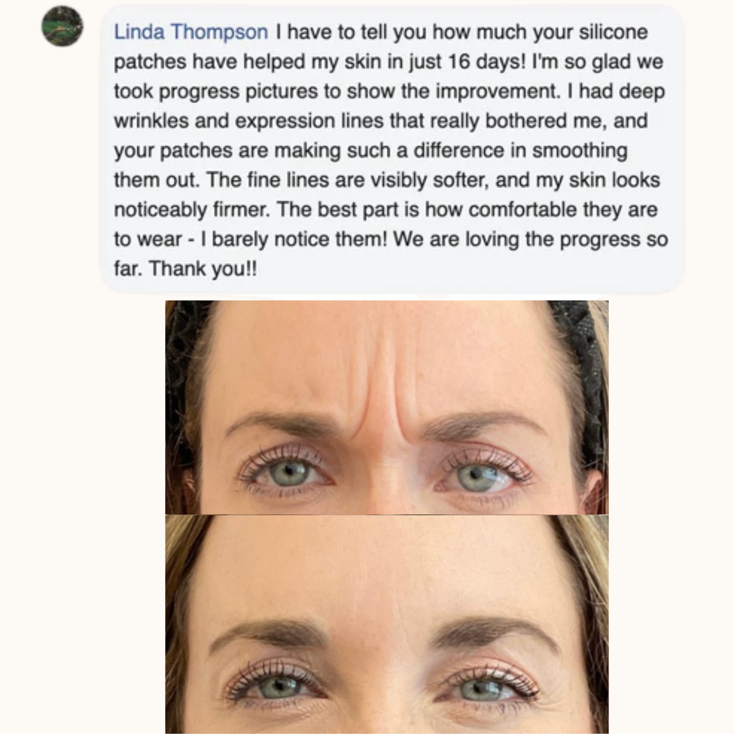 Losveo™ Forehead & 11 Lines Smoother